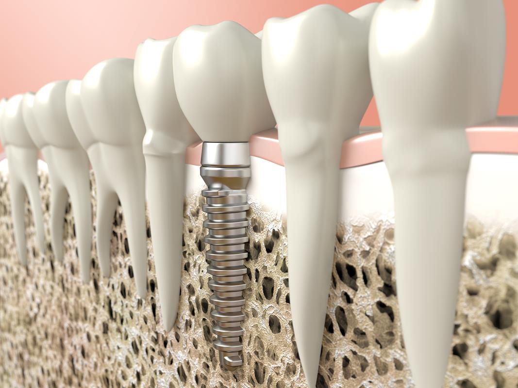 Dental Implants  Hollywood, FL